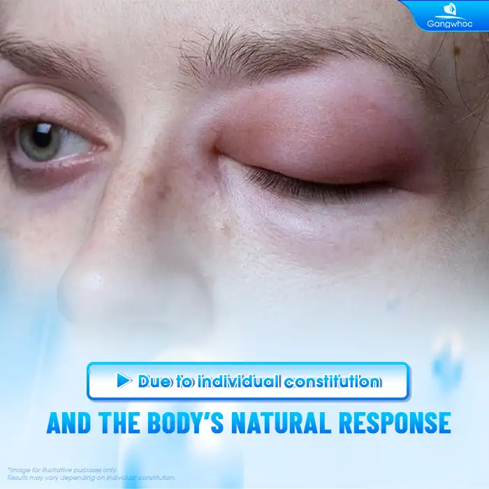 Why Is There Uneven Swelling After Double Eyelid Surgery? How Should It Be Managed?