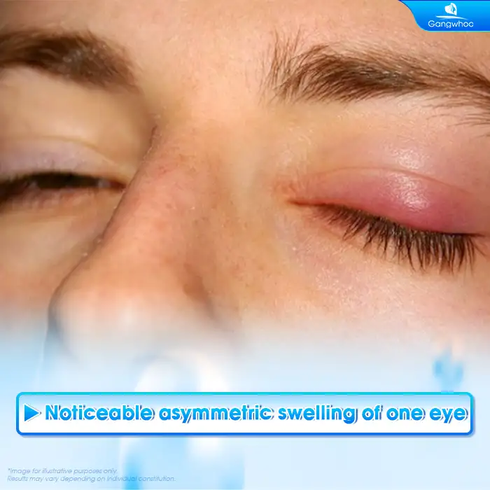 Why Is There Uneven Swelling After Double Eyelid Surgery? How Should It Be Managed?