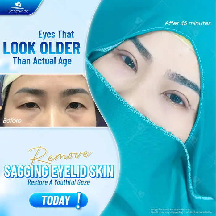 What is the lower eyelid fat removal method? How is the procedure performed?