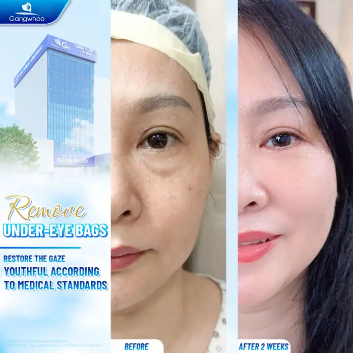 What is the lower eyelid fat removal method? How is the procedure performed?