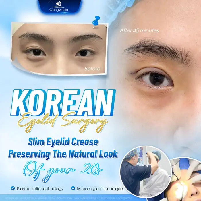 Is eyelid surgery advisable? What should be noted before undergoing the procedure?