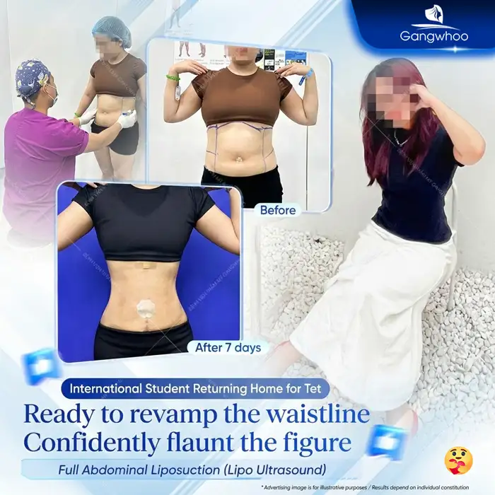 Is It Advisable to Undergo Abdominal Liposuction After Childbirth? Doctor’s Advice on the Appropriate Timing