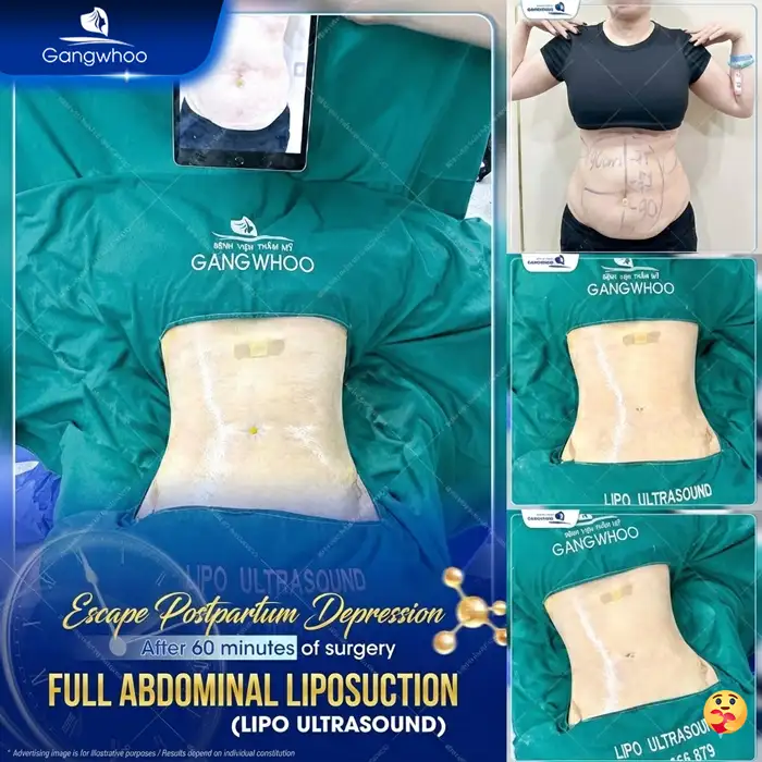 Is It Advisable to Undergo Abdominal Liposuction After Childbirth? Doctor’s Advice on the Appropriate Timing
