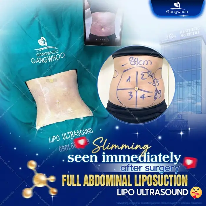 Is It Advisable to Undergo Abdominal Liposuction After Childbirth? Doctor’s Advice on the Appropriate Timing