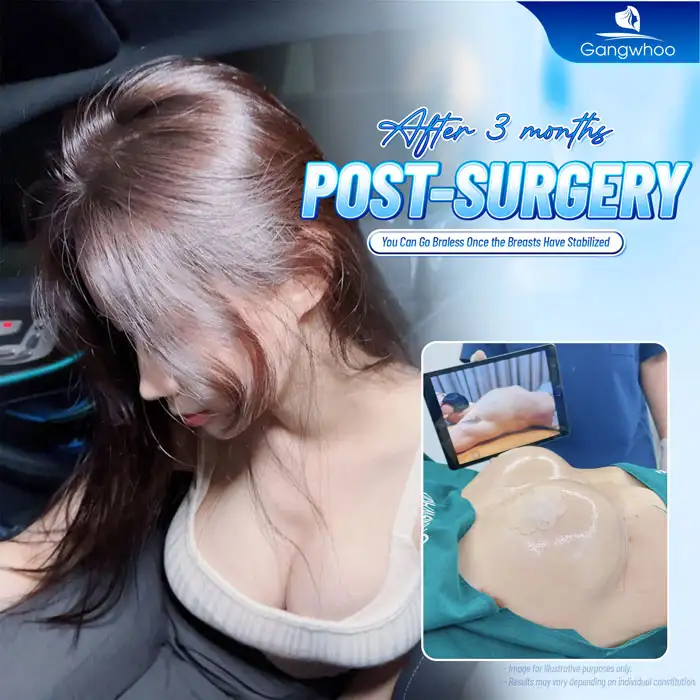 Should You Go Braless After Breast Augmentation? Does It Affect Breast Shape?