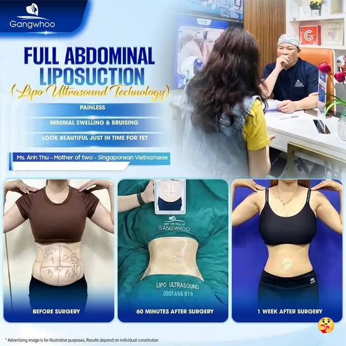 What Is Ultrasound-Assisted Liposuction? Is It Safe and Effective?