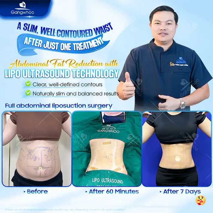 What Is Ultrasound-Assisted Liposuction? Is It Safe and Effective?