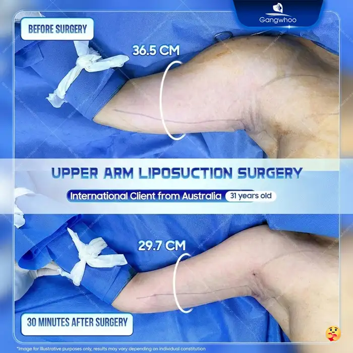 High-Tech Upper Arm Liposuction – A Safe Solution for Slim, Toned Arms at Gangwhoo 1 High-Tech Upper Arm Liposuction – A Safe Solution for Slim, Toned Arms at Gangwhoo