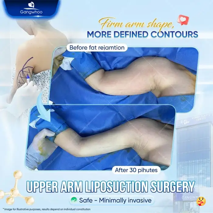 High-Tech Upper Arm Liposuction – A Safe Solution for Slim, Toned Arms at Gangwhoo 4 High-Tech Upper Arm Liposuction – A Safe Solution for Slim, Toned Arms at Gangwhoo