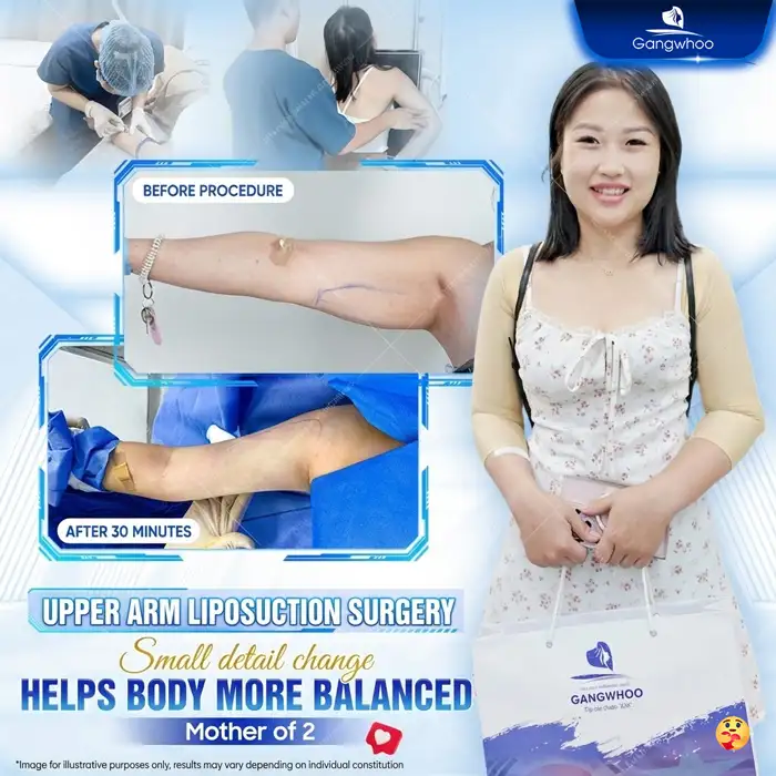 High-Tech Upper Arm Liposuction – A Safe Solution for Slim, Toned Arms at Gangwhoo 3 High-Tech Upper Arm Liposuction – A Safe Solution for Slim, Toned Arms at Gangwhoo