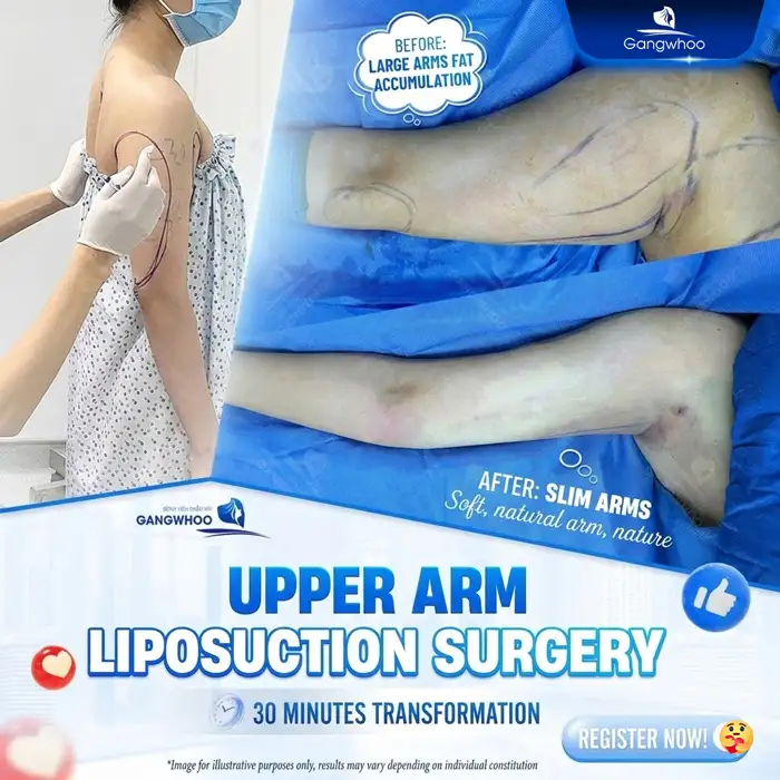High-Tech Upper Arm Liposuction – A Safe Solution for Slim, Toned Arms at Gangwhoo 2 High-Tech Upper Arm Liposuction – A Safe Solution for Slim, Toned Arms at Gangwhoo