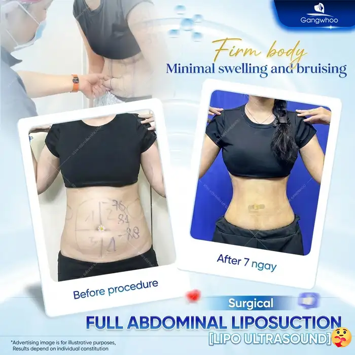 What Is Upper Abdominal Liposuction? Is It Painful and How Long Does Recovery Take?