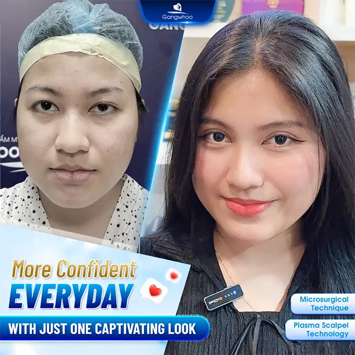 Should you choose eyelid stitching or double eyelid surgery? Which method is more beautiful and heals faster