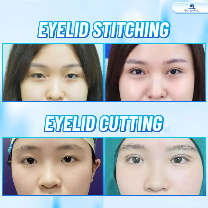 Should you choose eyelid stitching or double eyelid surgery? Which method is more beautiful and heals faster