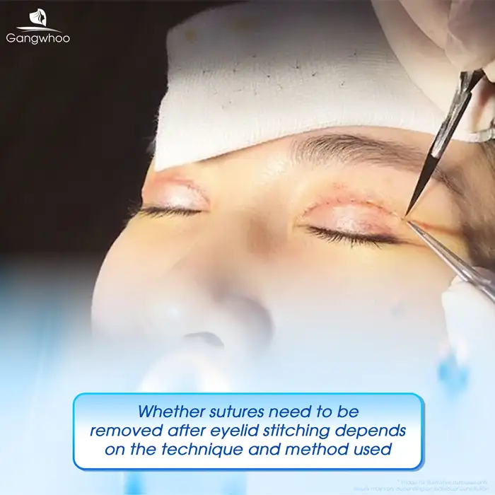 Does eyelid thread lifting require suture removal? When is suture removal necessary?