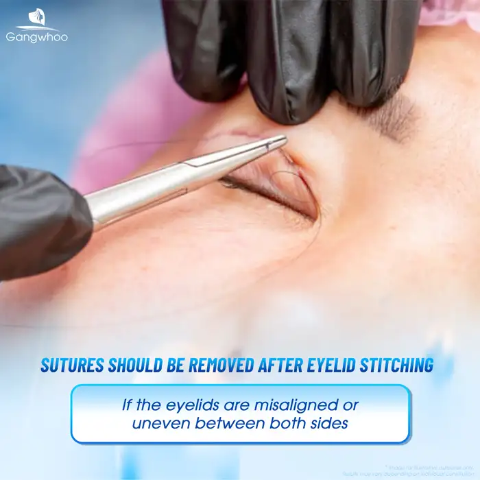 Does eyelid thread lifting require suture removal? When is suture removal necessary?