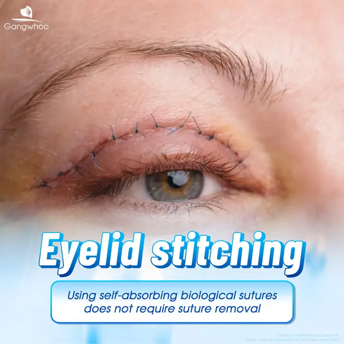 Does eyelid thread lifting require suture removal? When is suture removal necessary?
