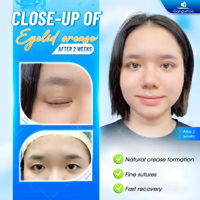 Does Eyelid Suture Removal Hurt? Does It Cause Any Effects?