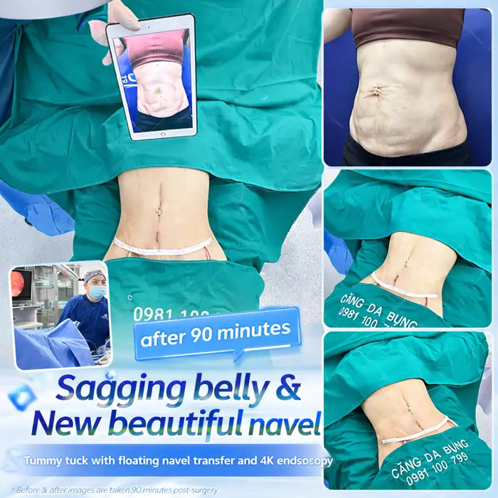 Is Abdominoplasty or Abdominal Liposuction Better? Which Method Is Most Effective?