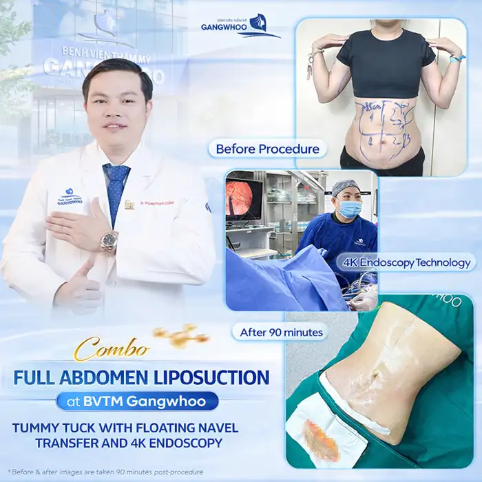Is Abdominoplasty or Abdominal Liposuction Better? Which Method Is Most Effective?