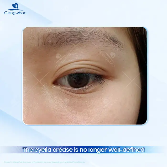 Detached Eyelid Muscle After Double Eyelid Surgery: Causes, Signs, and How to Manage It