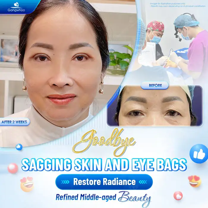 Lower eyelid surgery cost? Latest lower eyelid surgery price list 2025