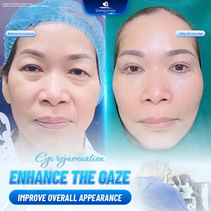 Lower eyelid surgery cost? Latest lower eyelid surgery price list 2025