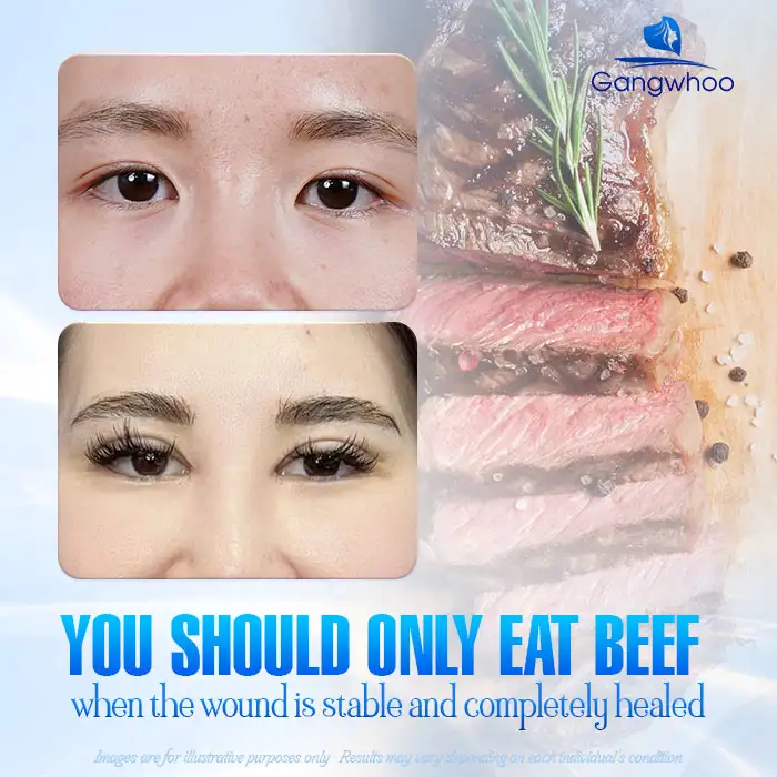After eyelid surgery, how long should you avoid beef to prevent affecting the wound?