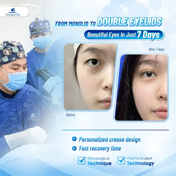 Where Is the Best Place for Eyelid Surgery? 11+ Reputable and Best Eyelid Surgery Addresses in Ho Chi Minh City