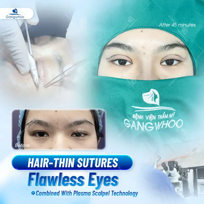 Where Is the Best Place for Eyelid Surgery? 11+ Reputable and Best Eyelid Surgery Addresses in Ho Chi Minh City
