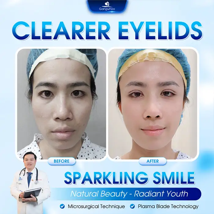 Have the wounds fully healed and stabilized 6 months after double eyelid surgery?