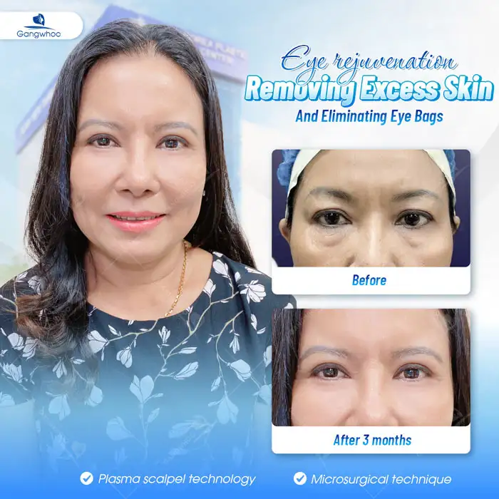 Youthful eyes with a fresh appearance, rejuvenating the gaze for brighter and more vibrant eyes