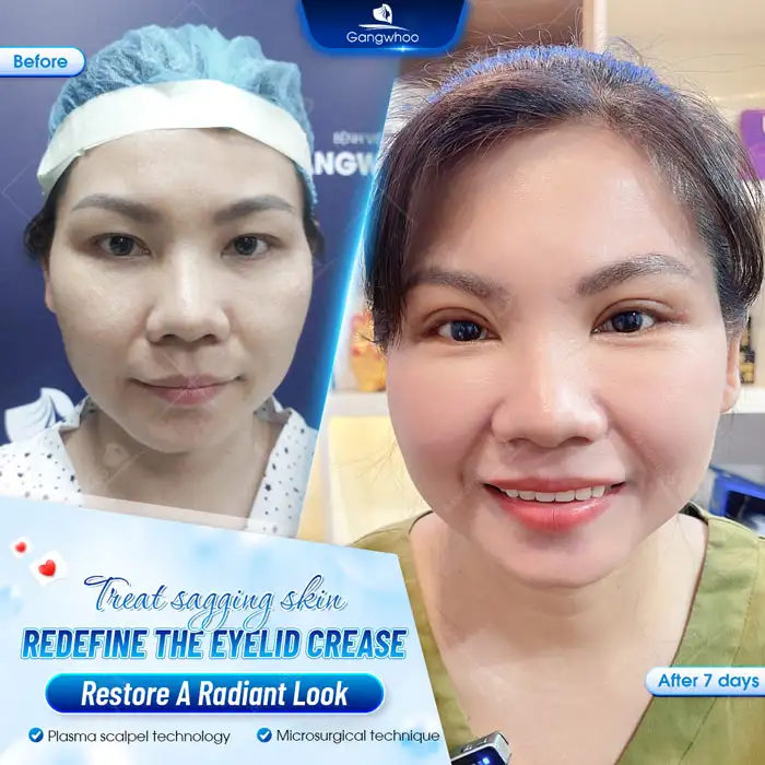 Creating a new eyelid crease to enhance the gaze and bring a more youthful appearance