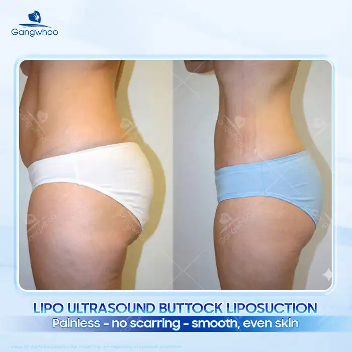 How Much Does Buttock Liposuction Cost Today? Updated Price List 2026