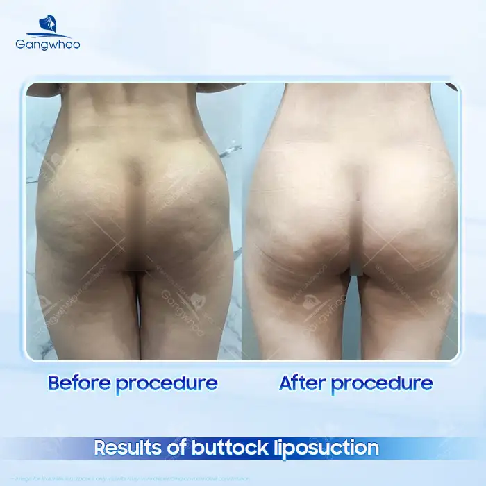 How Much Does Buttock Liposuction Cost Today? Updated Price List 2026