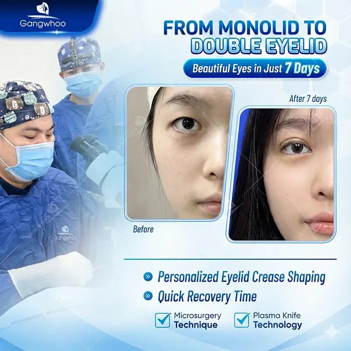 From monolid to beautiful double eyelids after only 7 days of personalized eyelid shaping