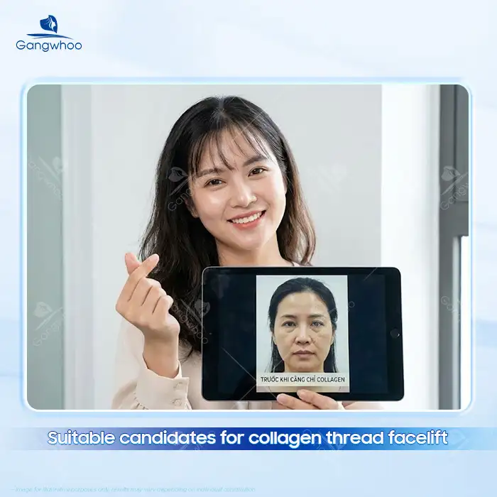 Should You Use Collagen Threads for Facelift? Advantages and Disadvantages of Collagen Threads