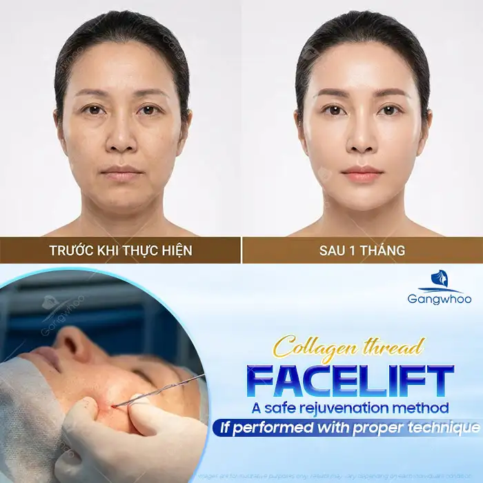Should You Use Collagen Threads for Facelift? Advantages and Disadvantages of Collagen Threads