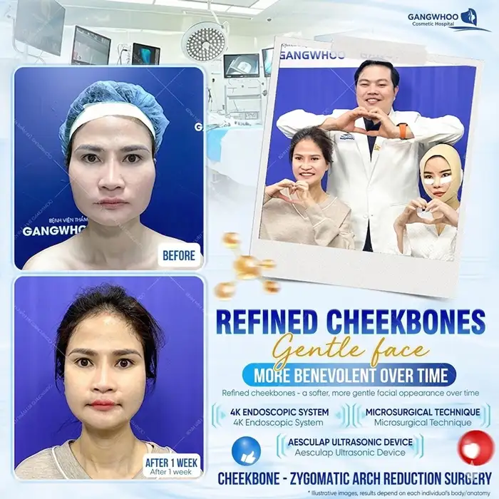 Is Cheekbone Reduction Permanent? Duration of Results After Cheekbone Reduction