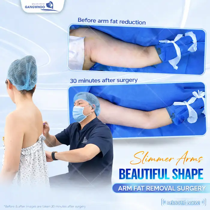 Arm Liposuction: How Long Does It Take to Heal? Medically Standard Recovery Time