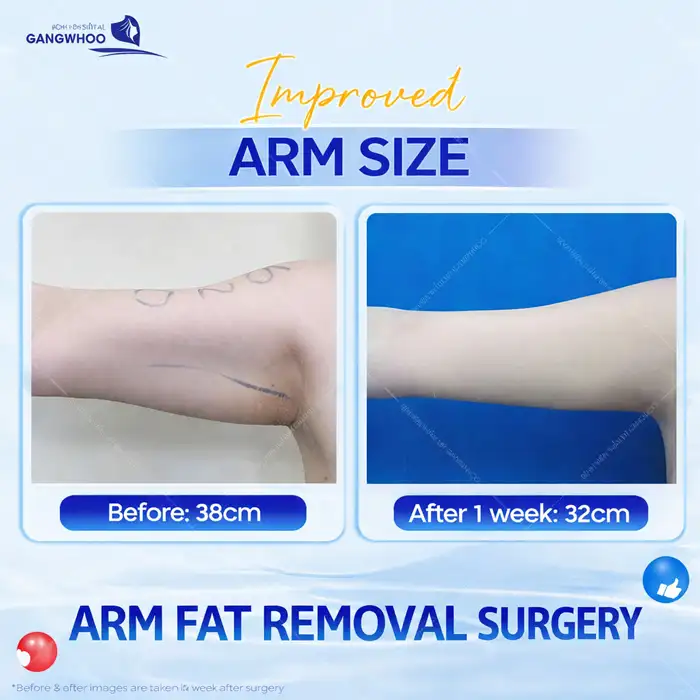 Arm Liposuction: How Long Does It Take to Heal? Medically Standard Recovery Time