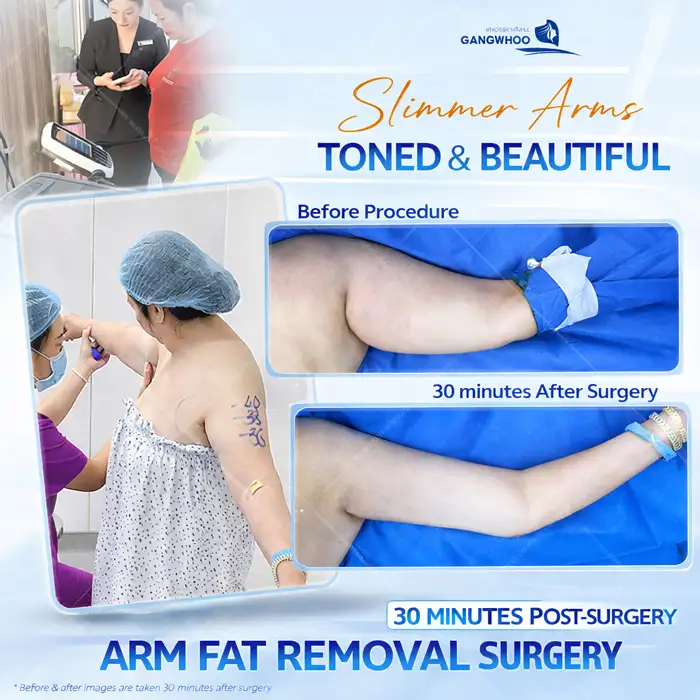 Arm Liposuction: How Long Does It Take to Heal? Medically Standard Recovery Time
