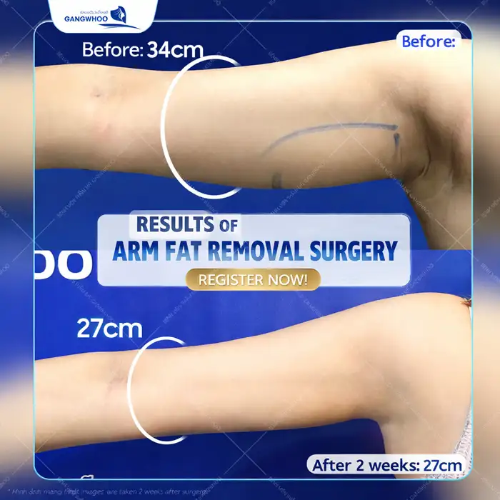 Arm Liposuction: How Long Does It Take to Heal? Medically Standard Recovery Time