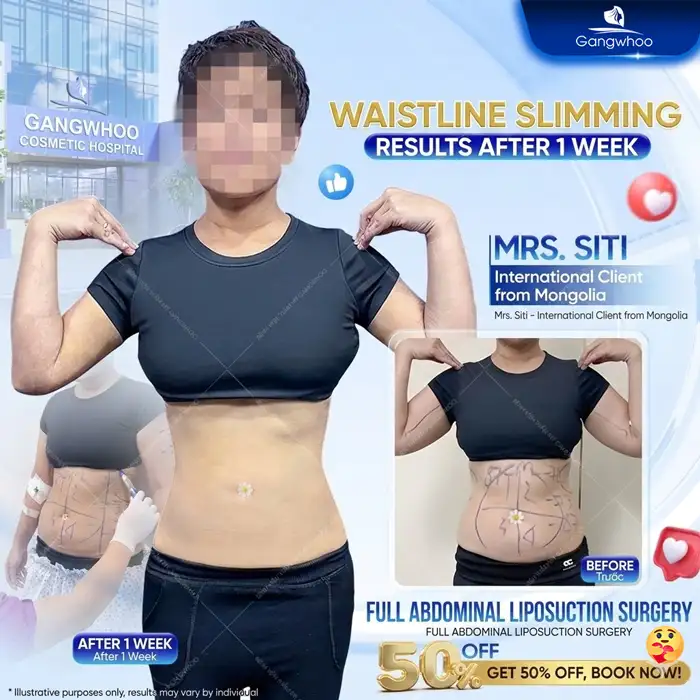 Where is a good place for abdominal liposuction in Hanoi? Top 5+ reputable and safe addresses