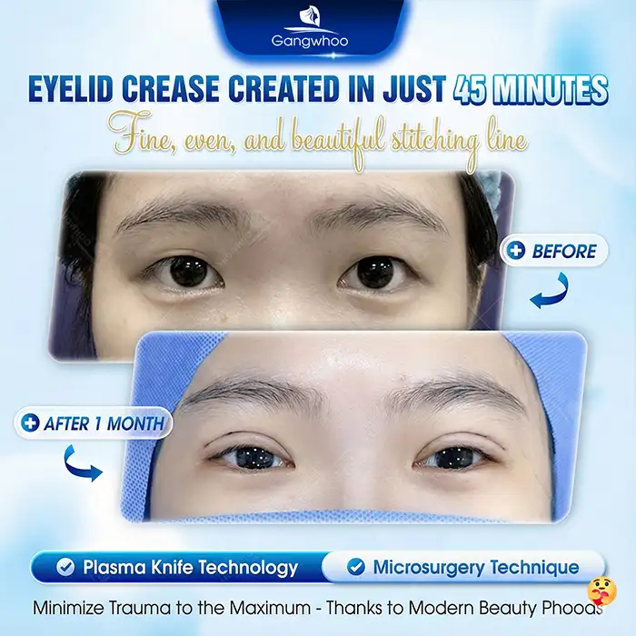 Should hooded eyelids undergo double eyelid surgery? Important safety considerations before surgery