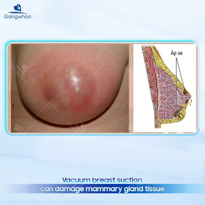Is Breast Enhancement with a Vacuum Suction Device Safe?