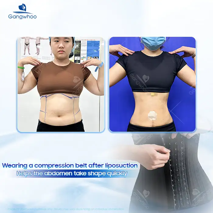Why Is It Necessary to Wear an Abdominal Compression Garment After Liposuction? How Long Should It Be Worn?