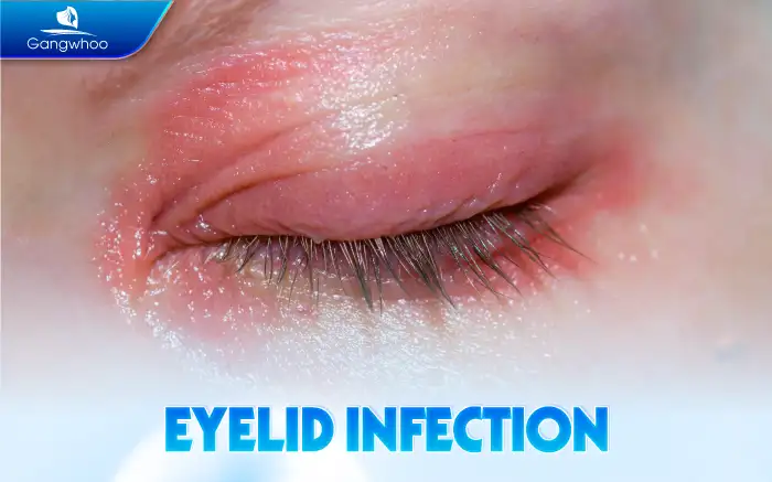 What Are the Side Effects of Eyelid Surgery? How Does It Affect Health?