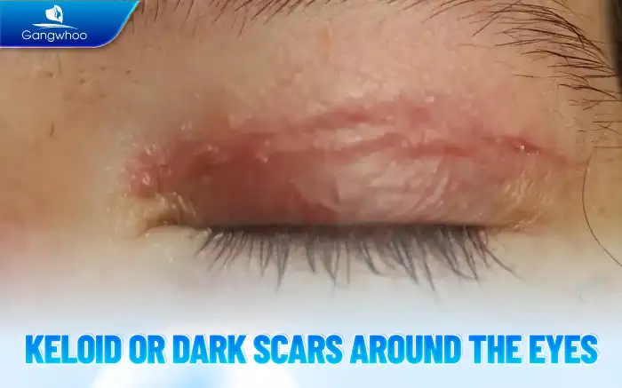 What Are the Side Effects of Eyelid Surgery? How Does It Affect Health?