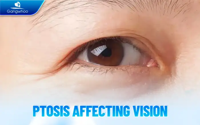 What Are the Side Effects of Eyelid Surgery? How Does It Affect Health?